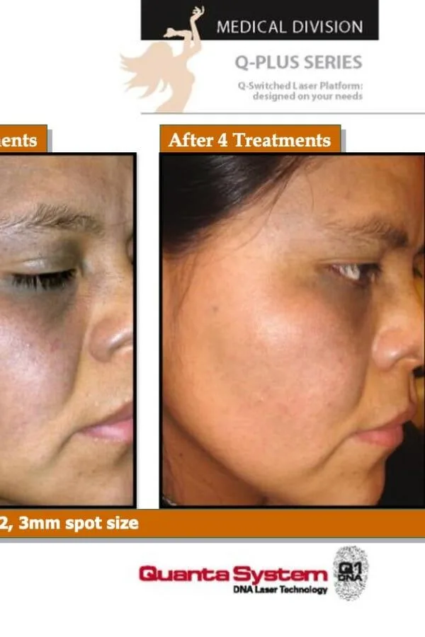 After Treatment