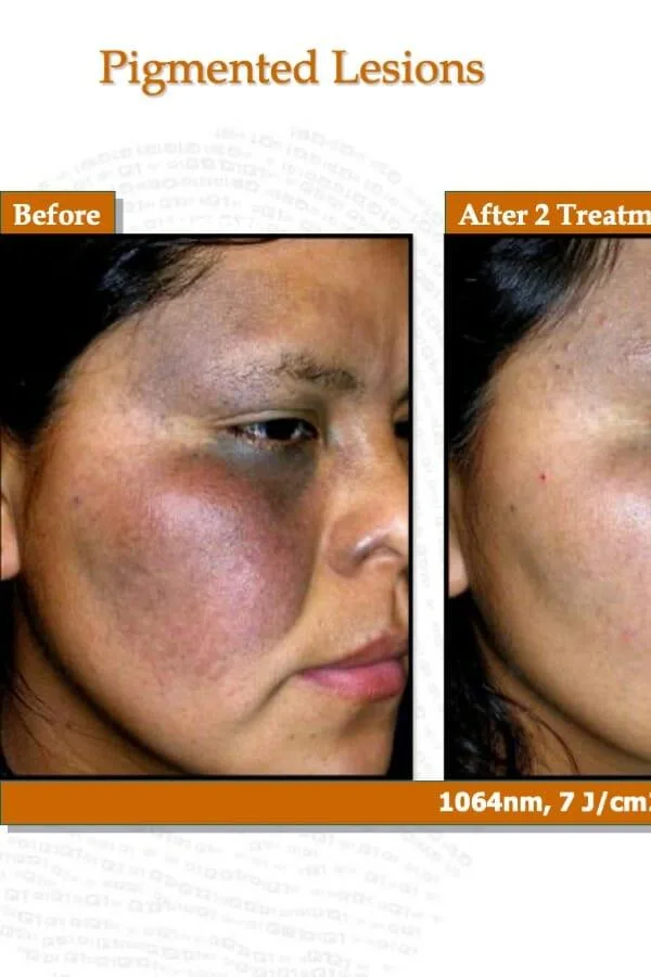 Before Treatment